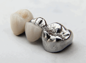 Dental Bridges