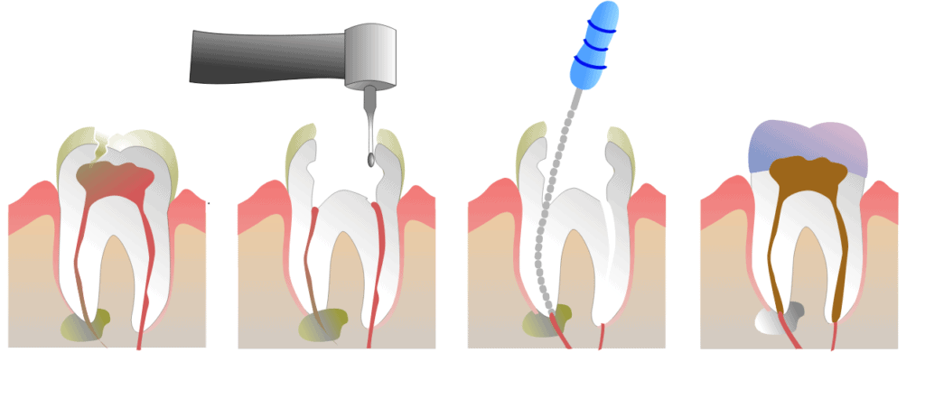 Root Canal Therapy