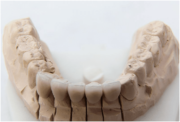 Dental Crowns