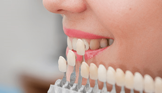 Dental Veneers