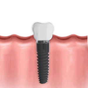 Dental Implants