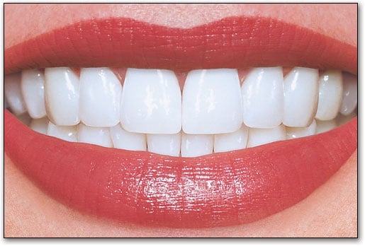 Porcelain Veneers