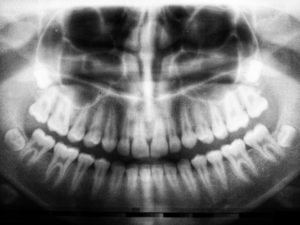 Dental X-Ray