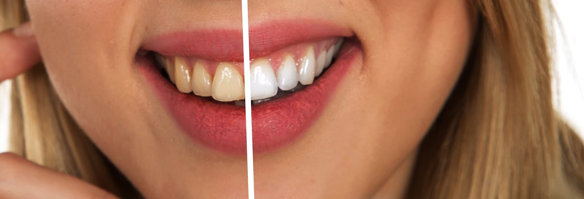 5 Questions to Ask Before Getting Teeth Whitening