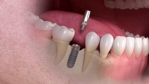 Are Dental Implants Painful? - Rodgers Dental - Affordable Dentist Edmonton