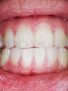 Oral Gums