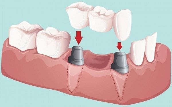 Dental Bridge Treatment | Dr. Molly Rodgers Dentist | Edmonton Smiles