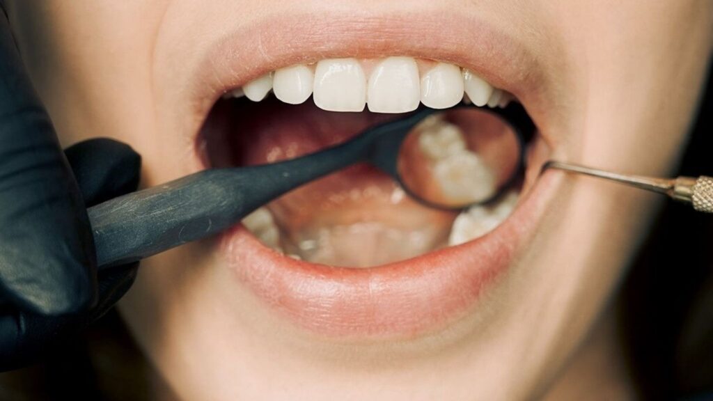 Healthy teeth being examined during a dental check-up at Edmonton Dentist clinic.