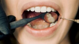 Healthy teeth being examined during a dental check-up at Edmonton Dentist clinic.