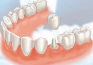 Dental Crowns Treatment