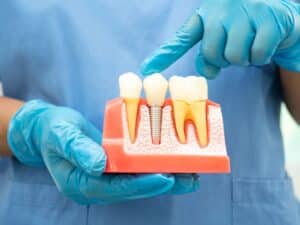 Root Canal Myths: Separating Fact from Fiction