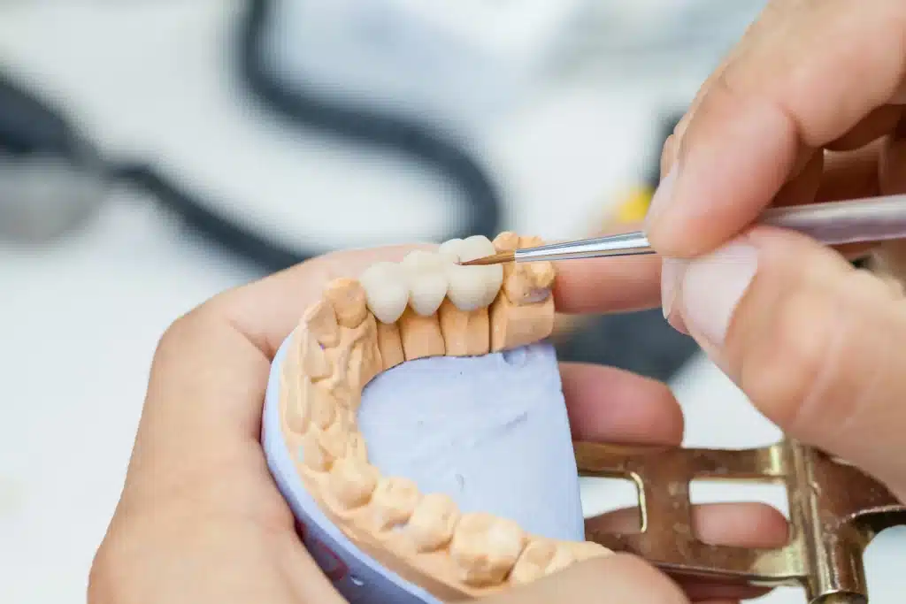 Dental Bridges