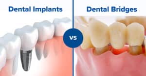 Dental Bridges Versus Dental Implants