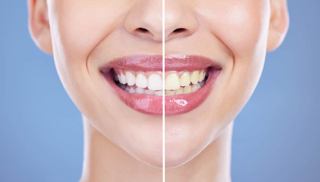 Cropped shot of a woman posing alone against a blue background after whitening her teeth