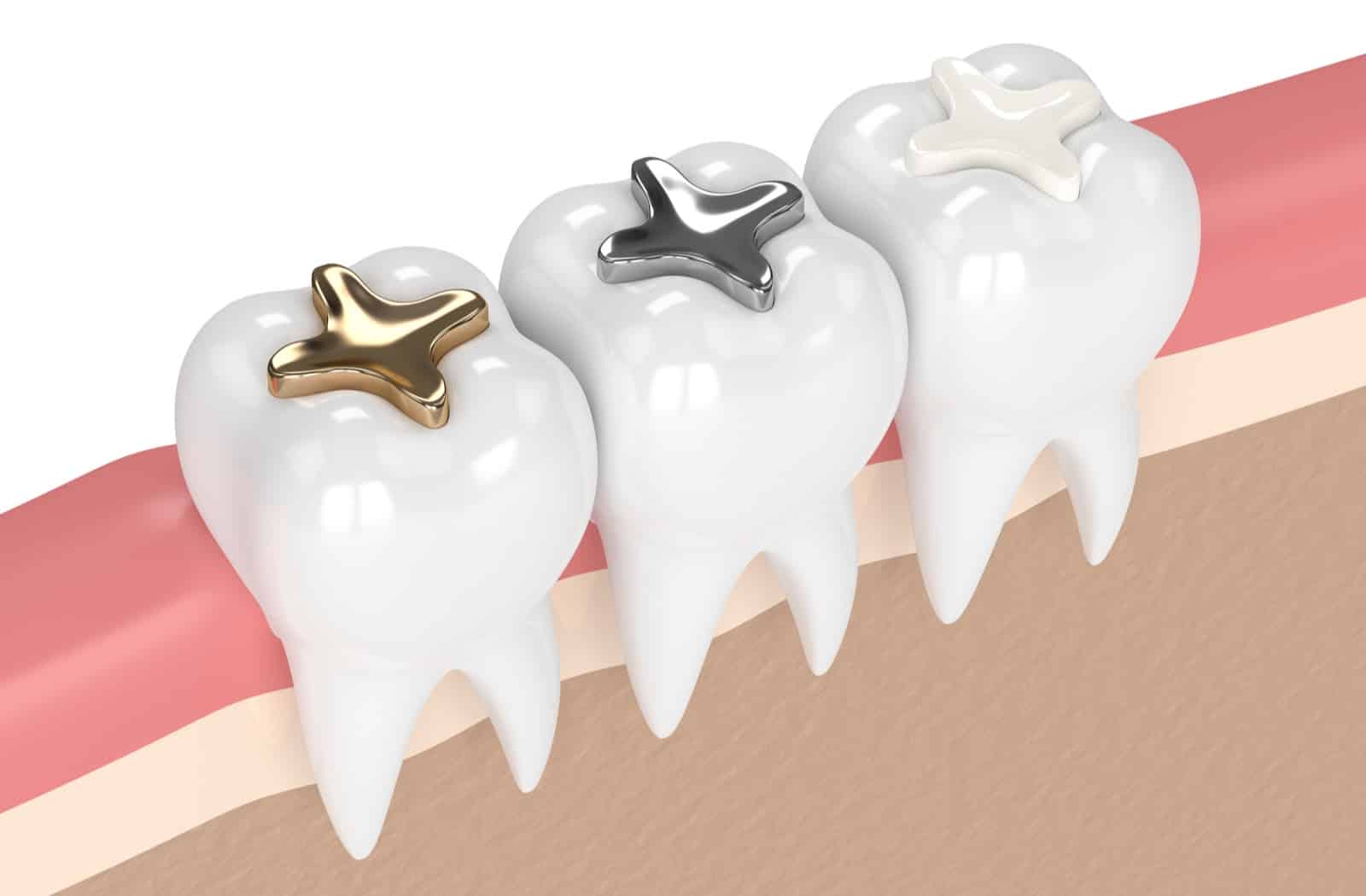 types-of-dental-fillings-supporting