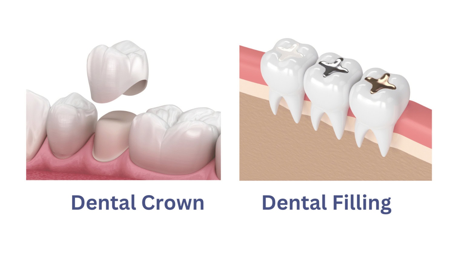 Dental-Crown-filling