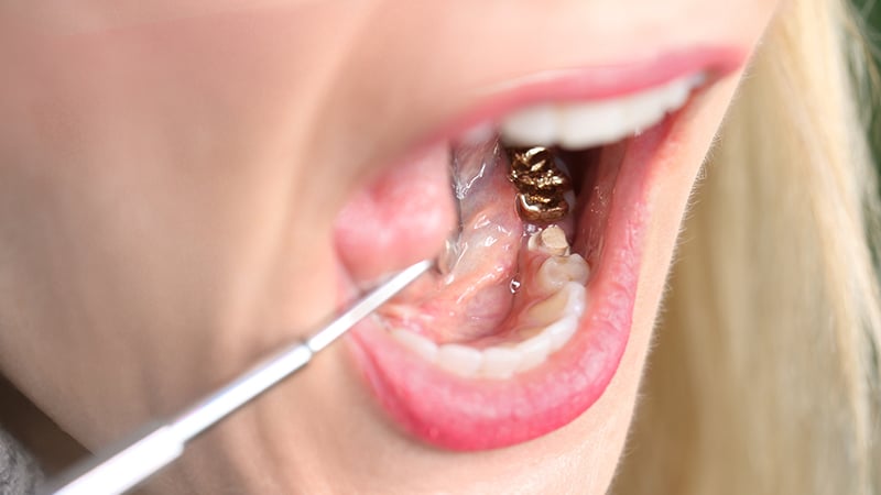 Gold-crown-on-molar-and-premolar