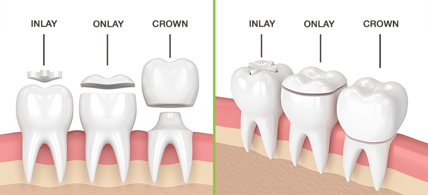 inlay-onlay-crown