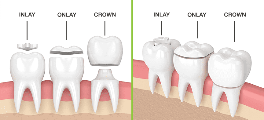 Crowns Vs Onlays Vs Inlays Understanding Your Dental Restoration Crowns Vs Onlays Vs Inlays Understanding Your Dental Restoration