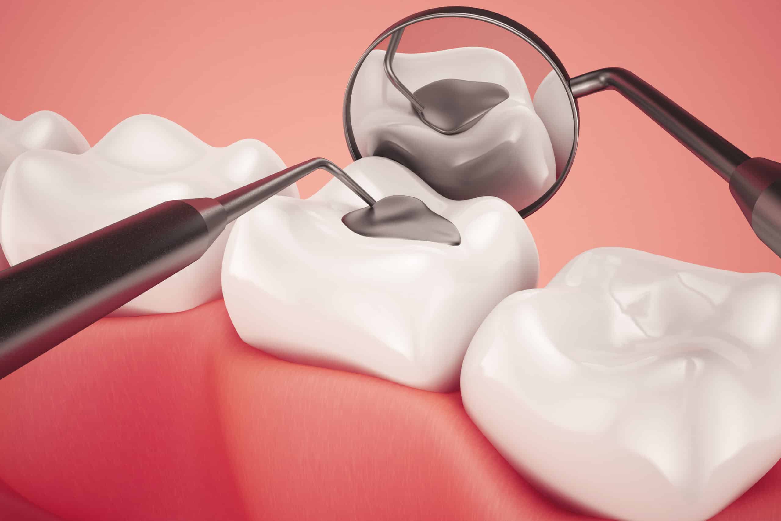 dental filling