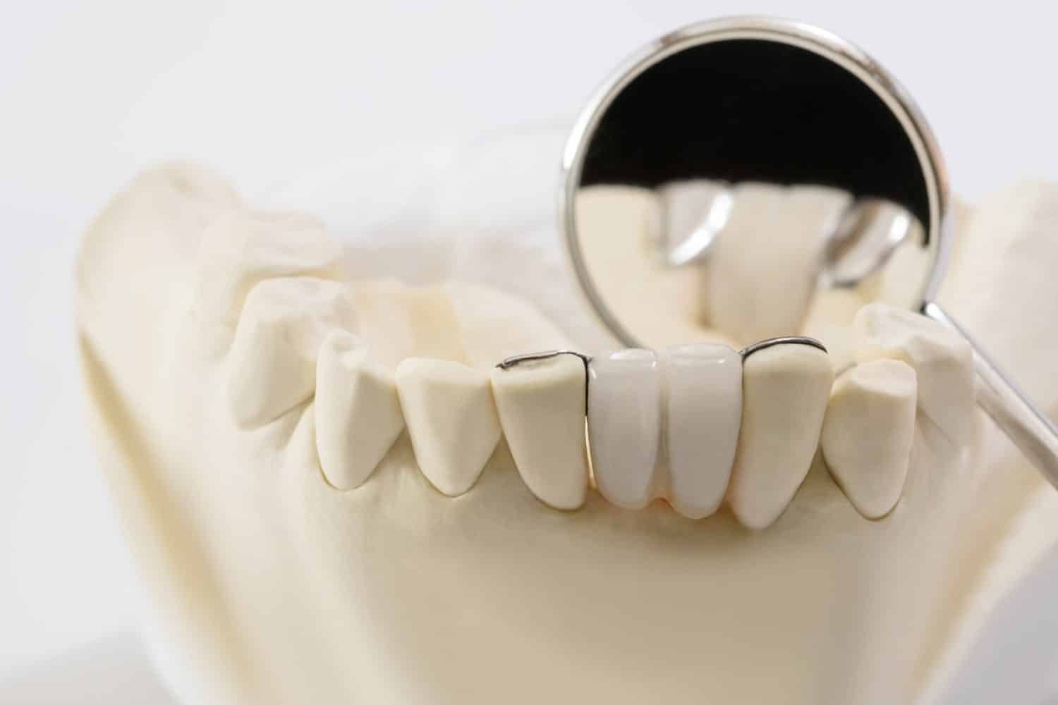 Can-You-Whiten-a-Dental-Bridge