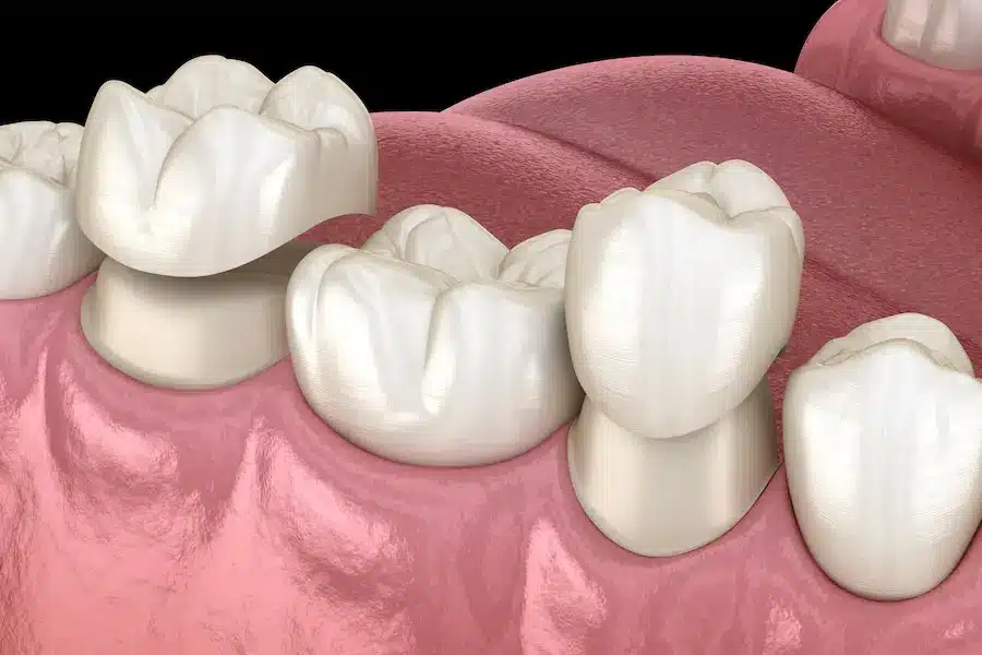 Why Your Crown Might Feel Loose