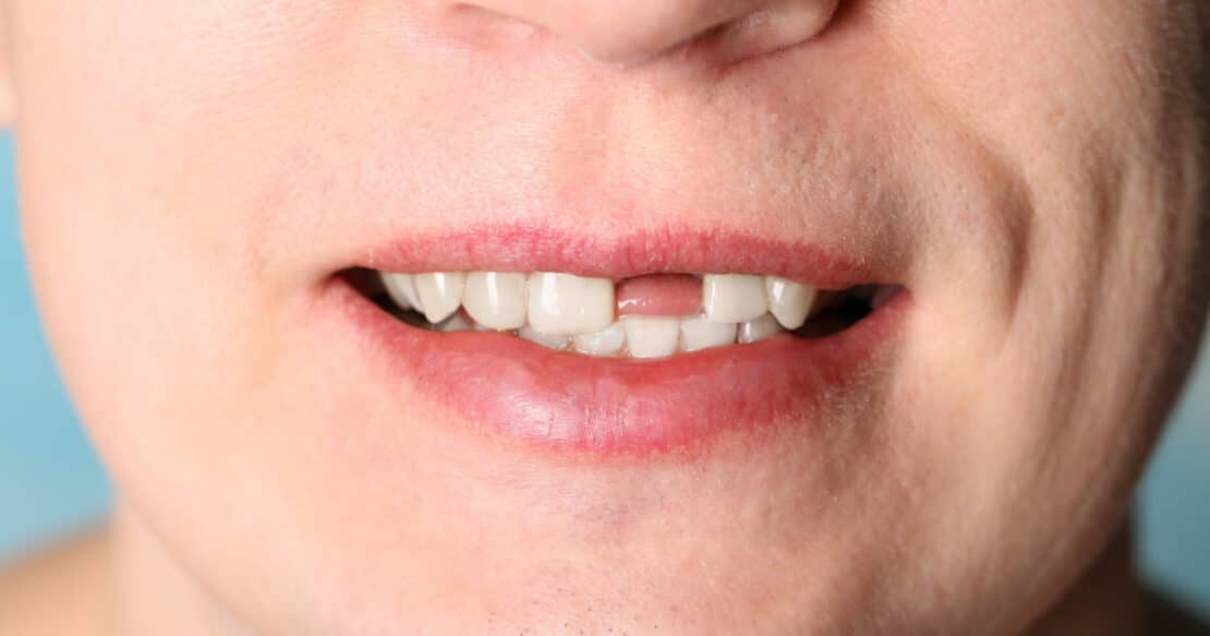 Smile without front tooth