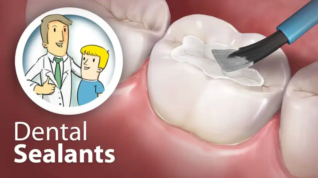 Dental Sealants Dr. Molly Rodgers dental