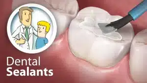 Dental Sealants Dr. Molly Rodgers dental