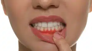 Early-Signs-of-Gum-Disease