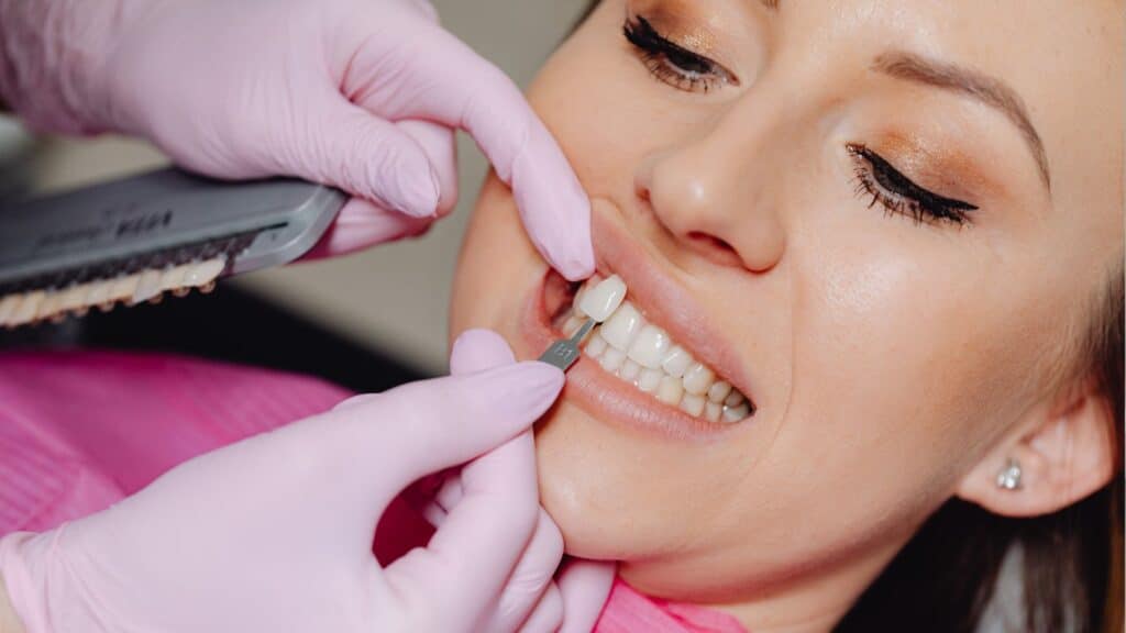How Long Do Veneers Last? What Affects Lifespan & How to Extend It