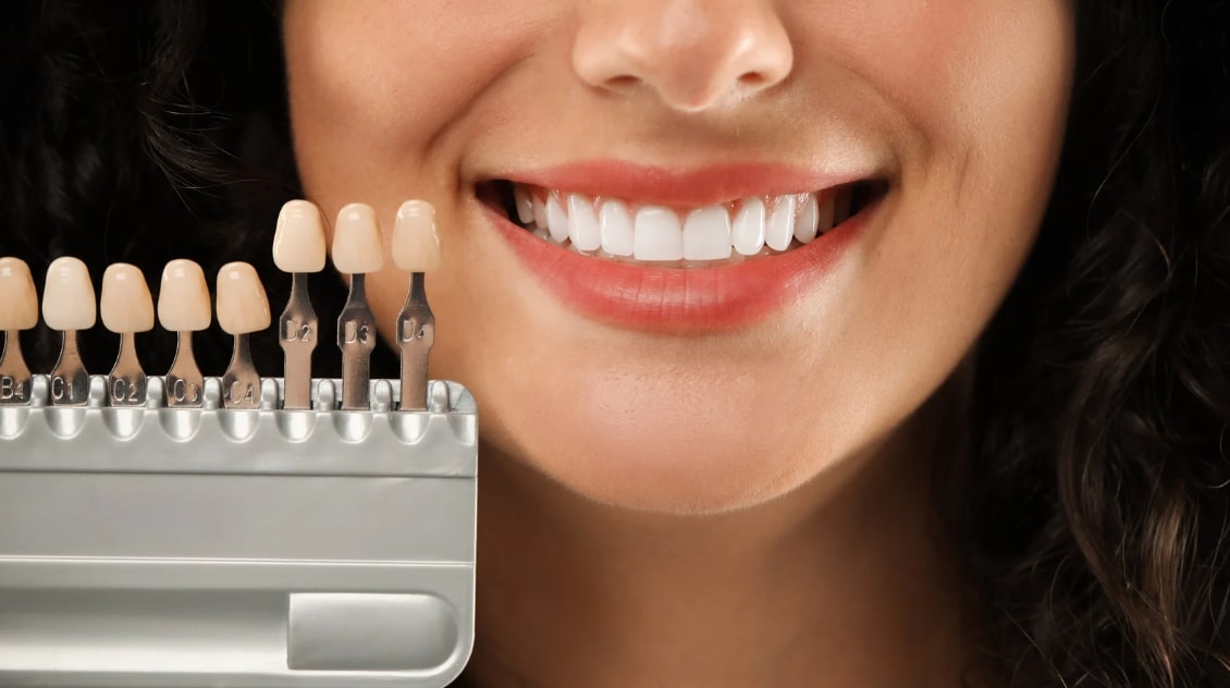 Teeth Bonding vs Veneers: Choose the Best Fix for Your Smile Fast