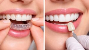 Invisalign Vs Veneers: Which Option Gives You The Smile You Really Want?