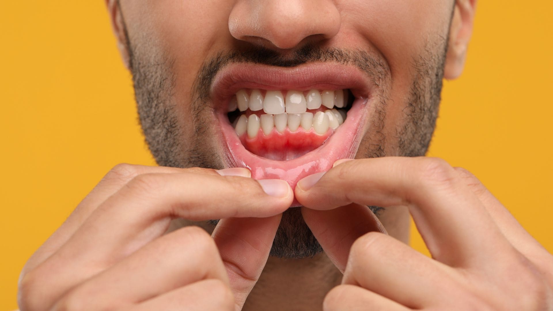Gum Graft Recovery Time: What to Expect Week by Week
