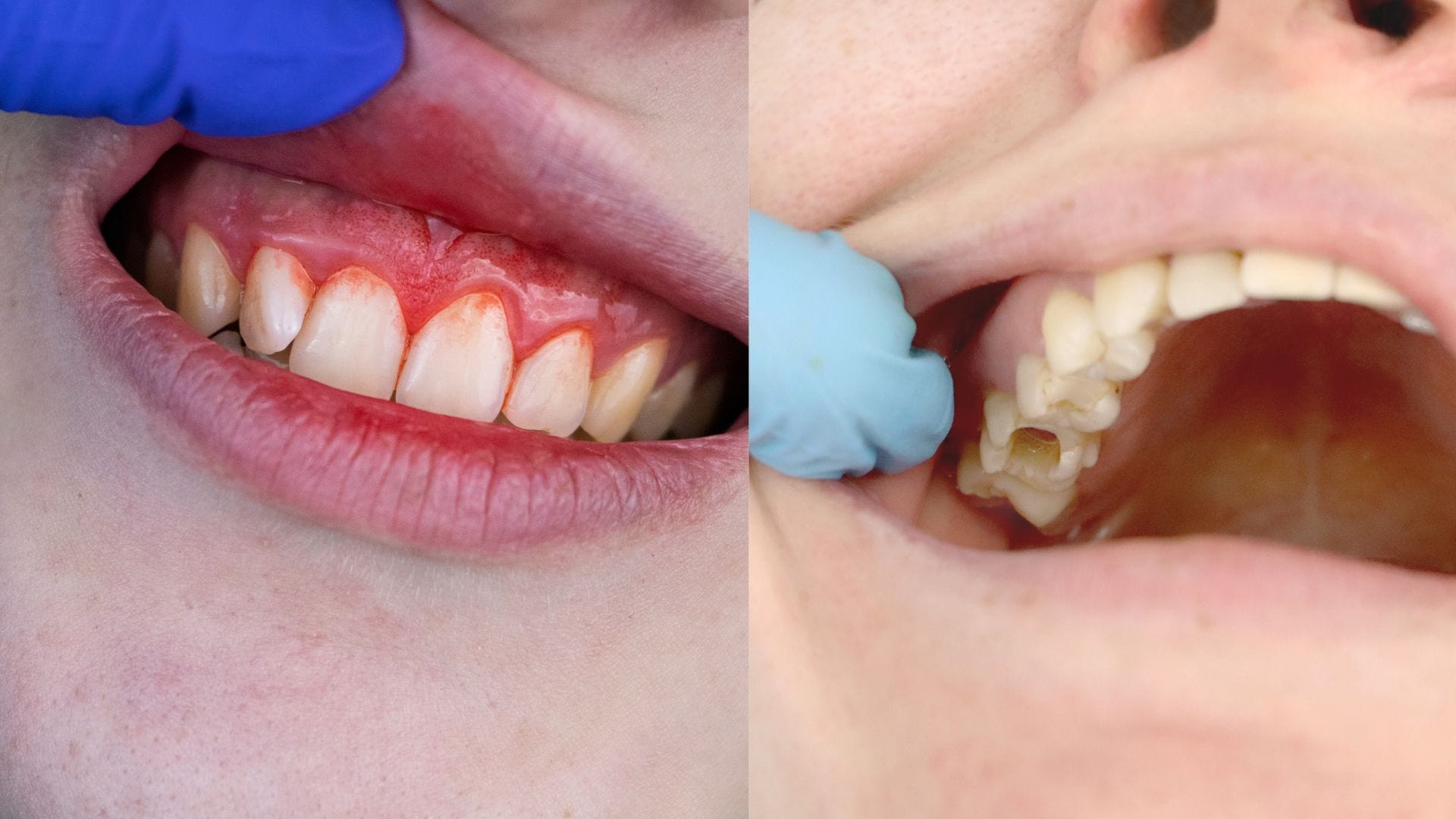 - Gum Infection Vs Tooth Infection: How To Tell The Difference And Why It Matters