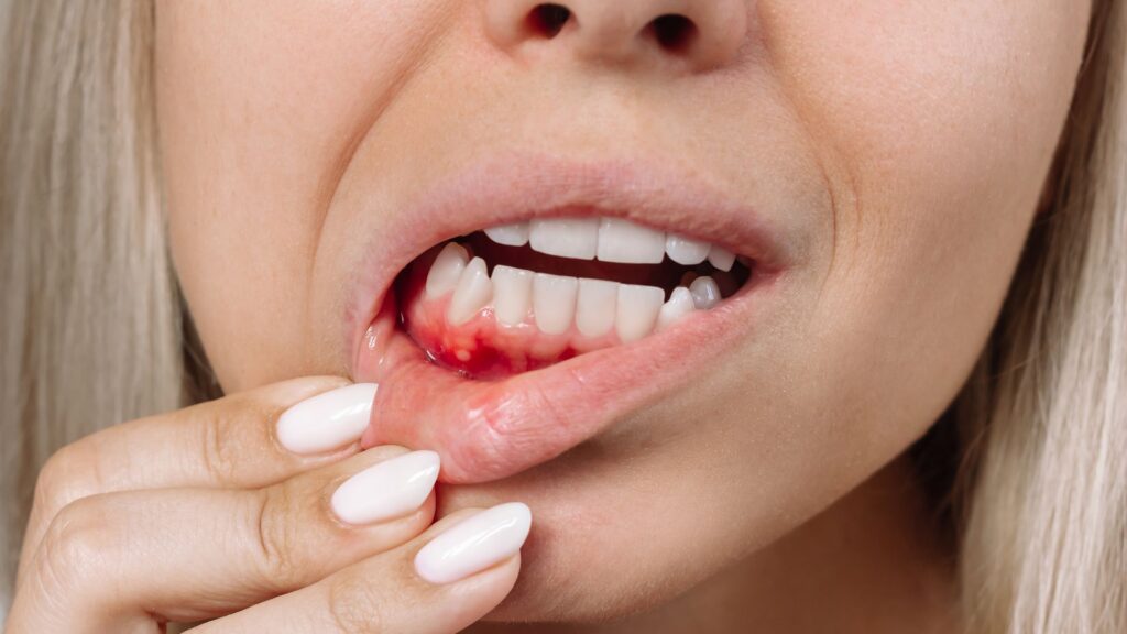 Close-up of a woman with bleeding gums and dental issues during pregnancy.