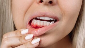 Close-up of a woman with bleeding gums and dental issues during pregnancy.