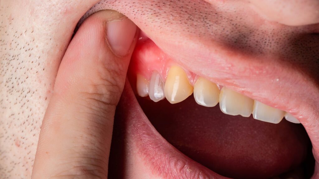 Close-up of bleeding gums and dental issues in a patient's mouth.