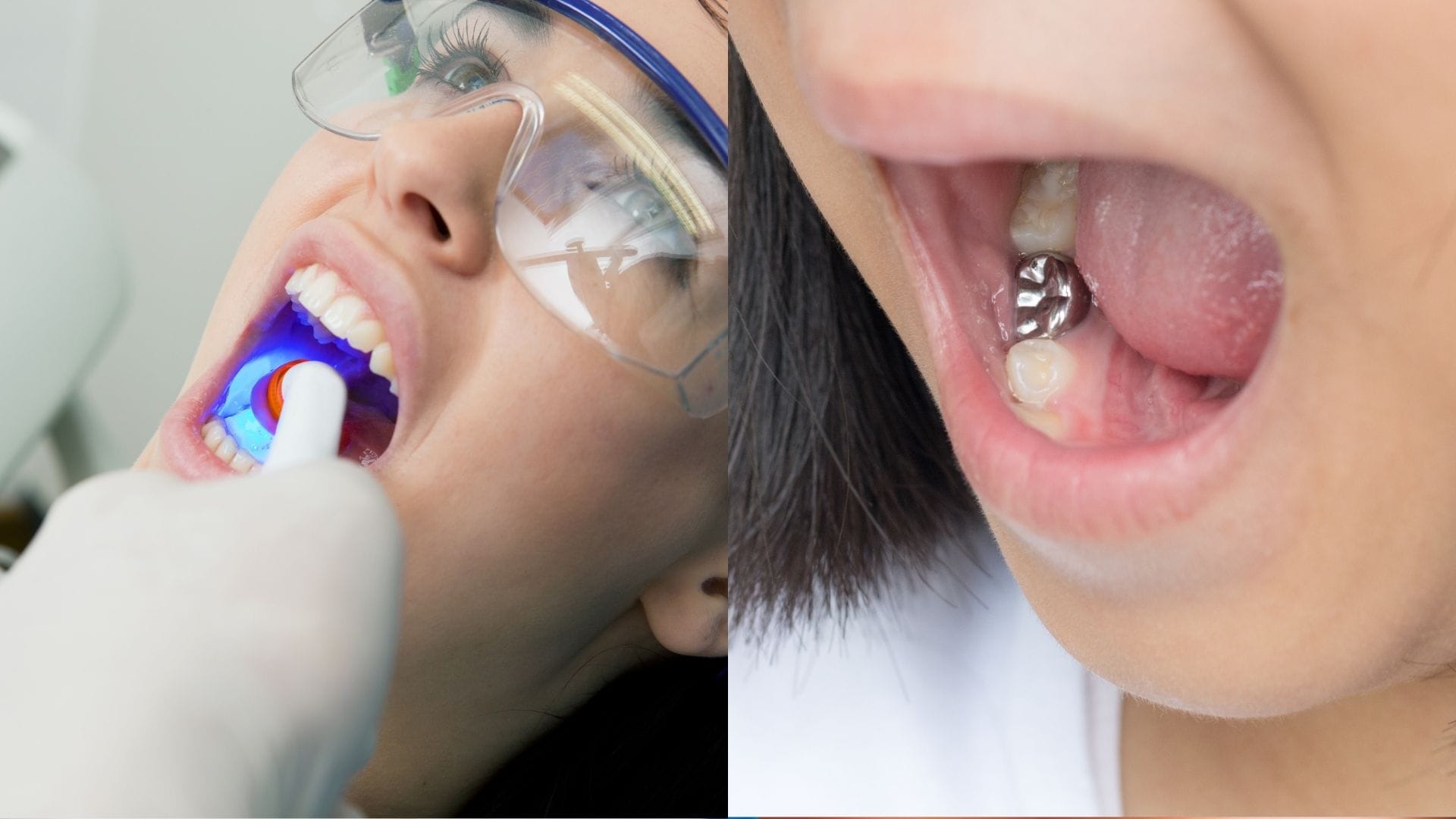 Silver Amalgam Vs Composite Resin: Which Filling Wins?