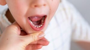 Close-up of a child's open mouth showing emerging teeth and a hand gently holding the chin.