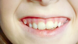 What Causes Supernumerary Teeth To Form?