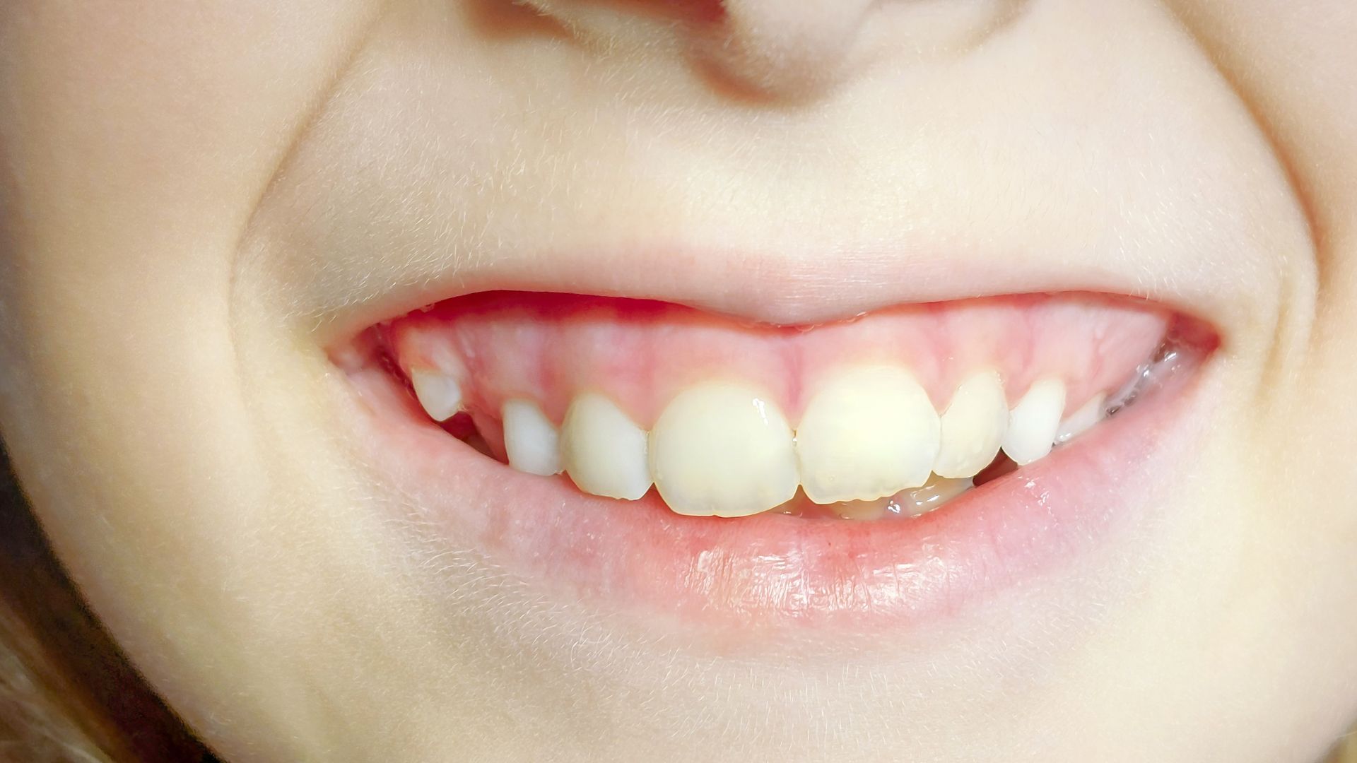 What Causes Supernumerary Teeth To Form?